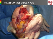 Transplantace srdce a plic