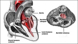 Aortální stenóza