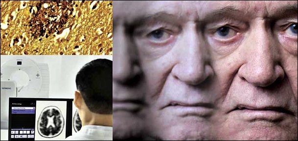 V současnosti trpí čtvrtina všech lidí starších 85 let demencí