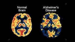Při Alzheimerově nemoci se do mozku ukládají špatně svinuté či poškozené bílkoviny beta-amyloid a tau protein. /Obr.: chm.bris.ac.uk/