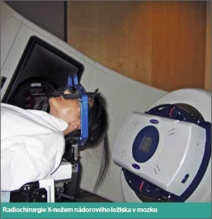 Radiochirurgie X-nožem nádorového ložiska v mozku