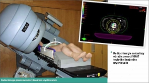 Radiochirurgie jaterní metastázy lineárním urychlovačem