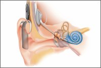 Schéma kochleárního implantátu