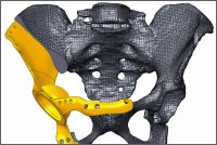 Sestava počítačového modelu pánve vytvořeného z CT dat pacienta a modelu implantátu