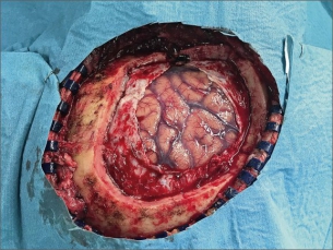 Poškozené mozkové pleny po kraniotomii