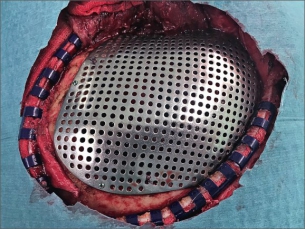 Implantát těsně před uzavřením operační rány