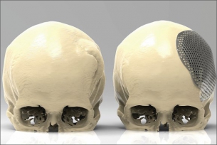 Srovnání stavu před a po kranioplastice s využitím 3D projekce