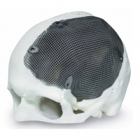 3D kovový tisk pomáhá zlepšovat lebeční a obličejovou chirurgii