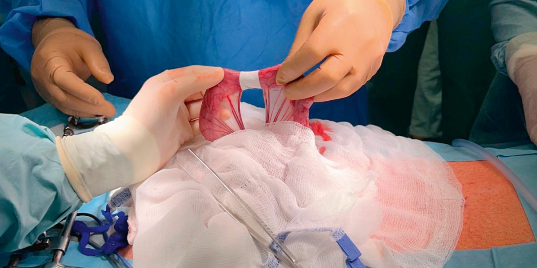 Hojivá nanovlákenná náplast z liberecké univerzity zabrání komplikacím po operaci střev