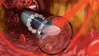 Znázornění funkce endoskopu při průchodu tepnou /Foto: Sterltech Optics/