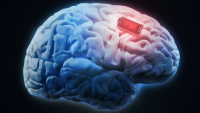 Hluboká mozková stimulace dokáže neurologické pacienty vrátit do aktivního života
