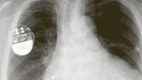 Nanotenký piezoelektrický materiál může pohánět medicínskou elektroniku Nanotenký piezoelektrický materiál může pohánět medicínskou elektroniku