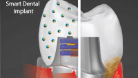 Pokročilý zubní implantát generuje elektřinu a léčí dáseň