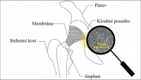 Takto může být situována nanomembrána v místě kyčelního kloubu