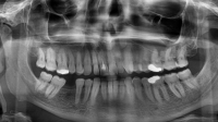 Nanotechnologie nabízí úlevu od bolesti při citlivosti zubů /Ilustrační obrázek/