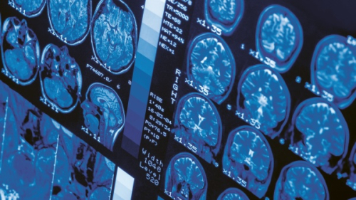 České senzory zpřístupňují výrazně šetrnější boj s nádory reálném čase