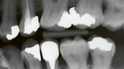 Strojové učení dokáže analyzovat rentgenové snímky zubů přesněji než zubní lékaři