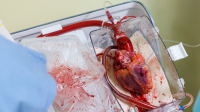 Systém TransMedics OCS™ Heart umožnil už přes 50 transplantací Systém TransMedics OCS™ Heart umožnil už přes 50 transplantací