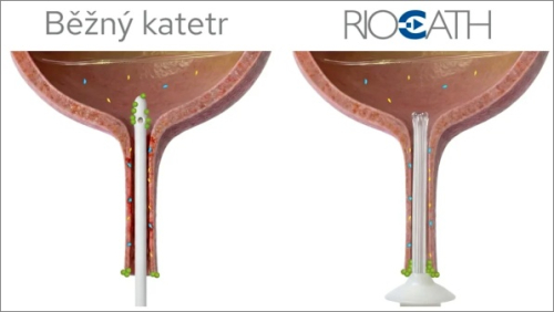 Česká technologie mění princip katetrizace