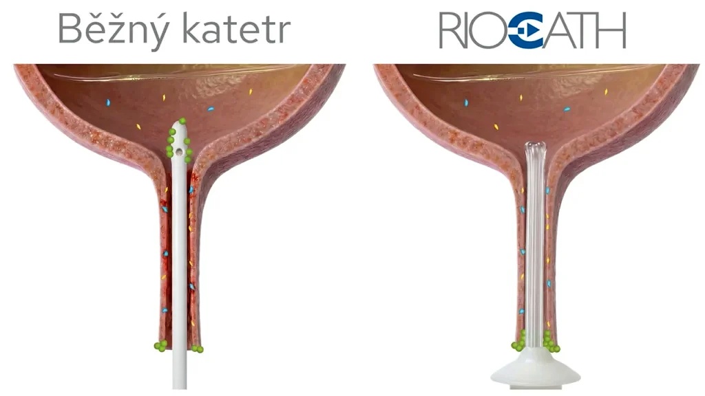 Česká technologie mění princip katetrizace